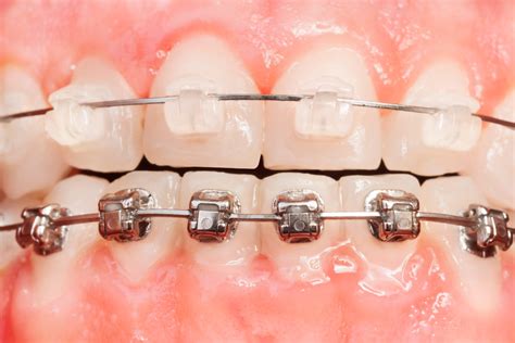 diferencia entre brackets metalicos y esteticos|brackets aesthetics en espanol.